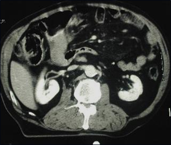 Multi-trauma-duodenal hematoma-5